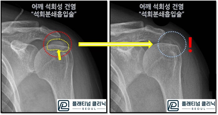 (플래티넘의원) 극심한 어깨 통증. 석회성 건염의 치료. 한번의 시술로 치료가능합니다.