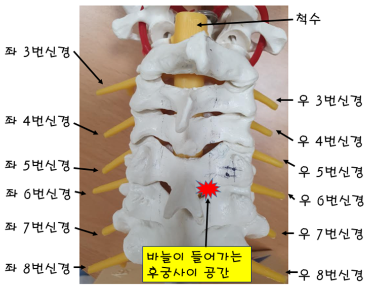 경추 신경주사(신경차단술), 설명사진 및 영상 : 네이버 블로그
