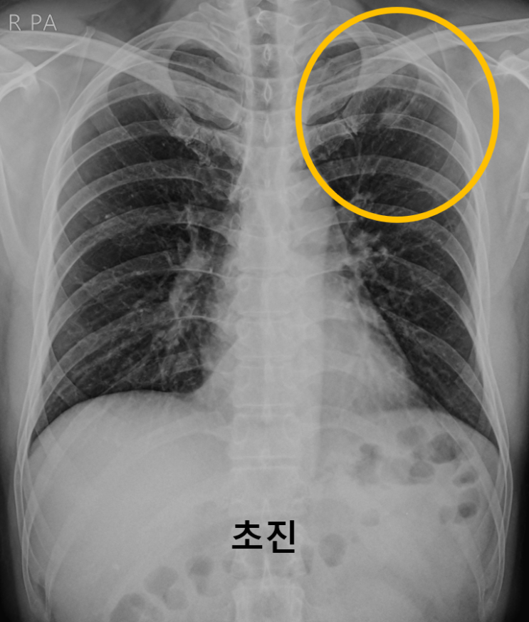 활동성결핵 VS 비활동성결핵 (풍암동 소문난내과) : 네이버 블로그