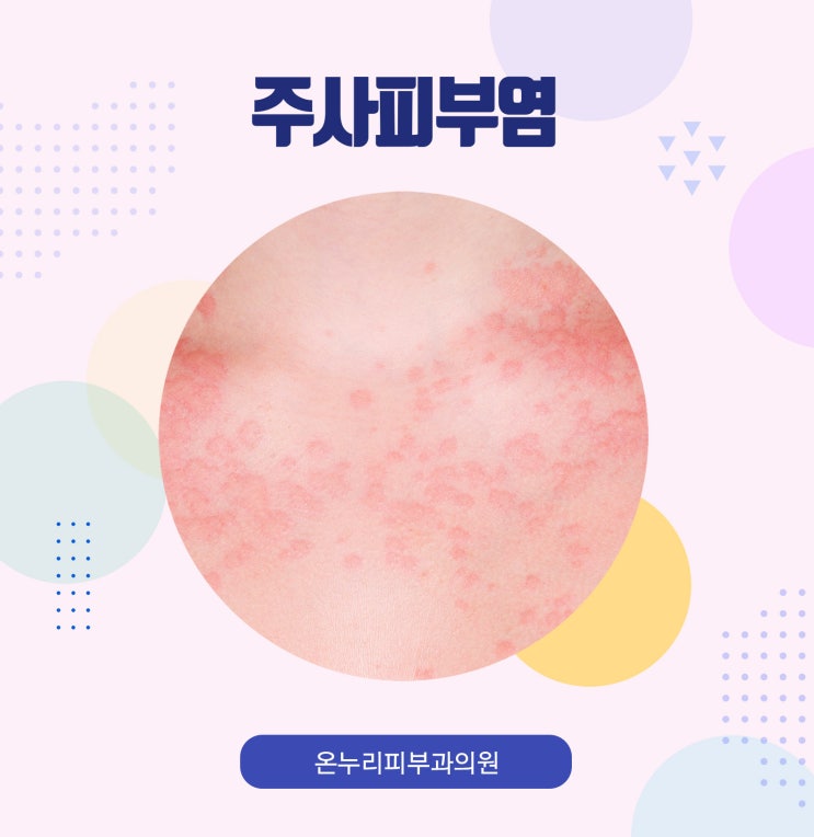 주사피부염 치료, 다른 피부염과 헷갈리지 않게! : 네이버 블로그