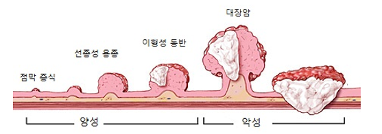 일산 한사랑속편한내과와 알아보는 대장암으로 발전 가능성 높은 대장용종 : 네이버 블로그
