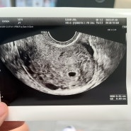 [4주 5일차] 아기집 확인 , 임신 확인증 발급 완료!