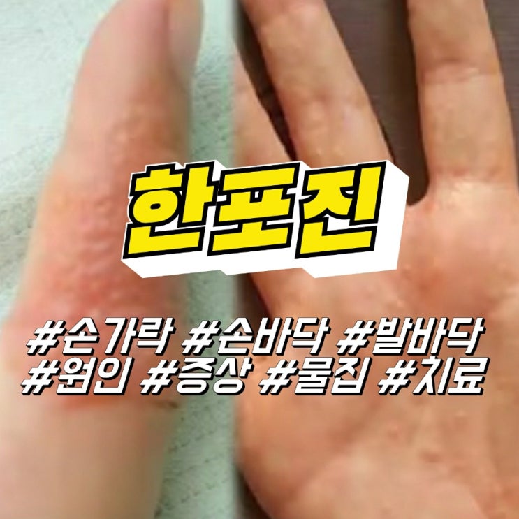 손가락 손바닥 발바닥 한포진 원인 및 증상, 피부 수포 물집 치료 : 네이버 블로그