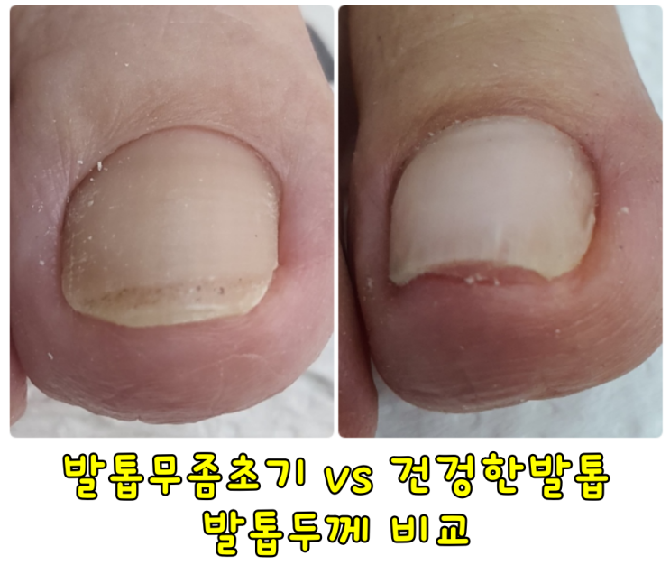 구리네일샵'손끝향기' - 발톱무좀초기증상 (발톱무좀초기관리) : 네이버 블로그