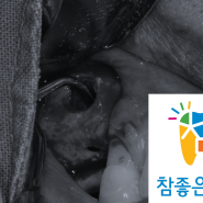 이 씌운 게 빠졌어요 - 치관-치근 파절 치아 발치 후 상악동 거상술(측방 접근법)을 이용한 임플란트 식립(feat. 치경부 레진 충전)