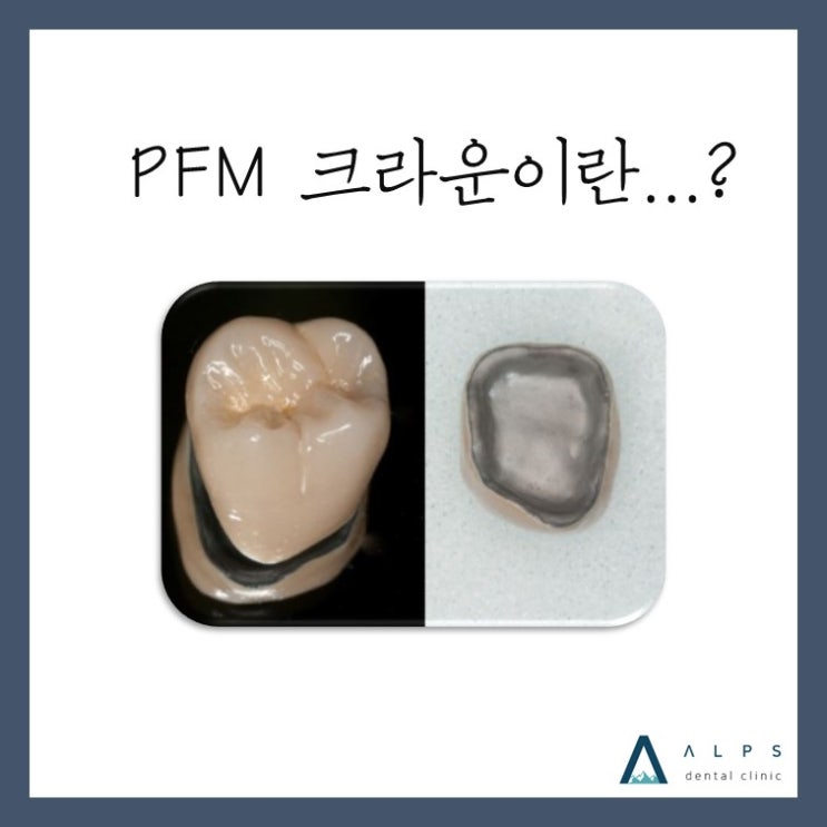 (인천계양구치과)크라운 보철 
