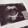 헬로베이비2 :: 임신 36주, 중증근무력증환자 임신, 루푸스환자임신, 동산병원 산부인과