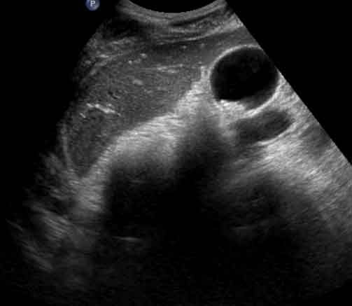 Cholelithiasis and choledocholithiasis : 네이버 블로그