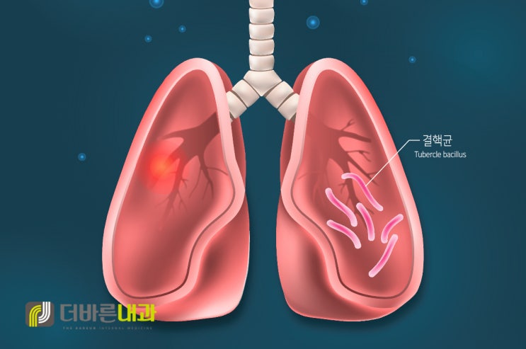 양산 폐결핵!!! 증상과 예방법은? : 네이버 블로그