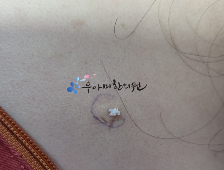 회음부 종기 대처 방안 (바톨린낭종 제거에 대한 새로운 시각) : 네이버 블로그