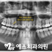 케이스리뷰) 치아 사이 깊은 충치로 신경치료 / 포항 치과 추천 예스치과의원