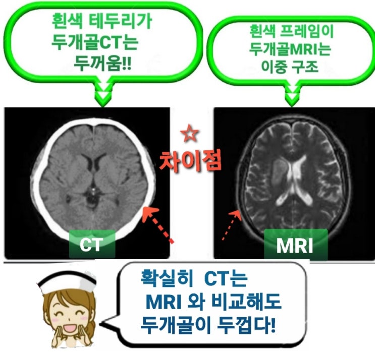 Early CT Sign 이란?CT 영상으로 뇌출혈 뇌경색 보기 : 네이버 블로그