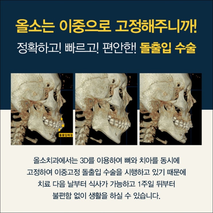 무턱수술비용 돌출입도 부담없이 만족스럽게 : 네이버 블로그