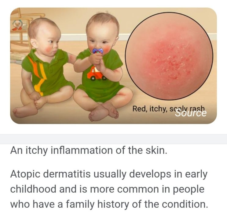 아토피 영어로!! (atopy 아님) : 네이버 블로그