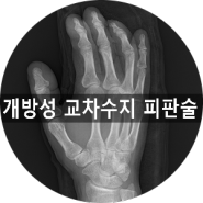 [부산 성가병원] 개방성 교차수지 피판술의 수술사례입니다.