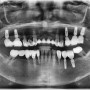 동천동 치과 에서 발치 후 즉시식립 을 통해 수술의 부담을 줄여드립니다.
