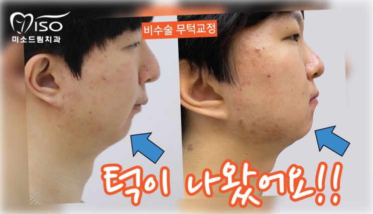 무턱 수술 vs 무턱 교정 이렇게 다릅니다! : 네이버 블로그