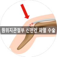 [부산 성가병원] 원위지관절부 신전건이 파열된 환자분의 수술사례입니다.