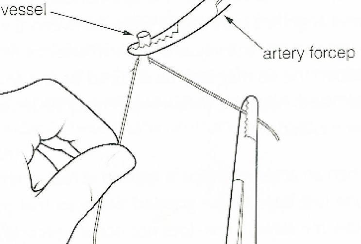 결찰(ligation)방법, suture tie, tie, stapling, clamp종류 : 네이버 블로그