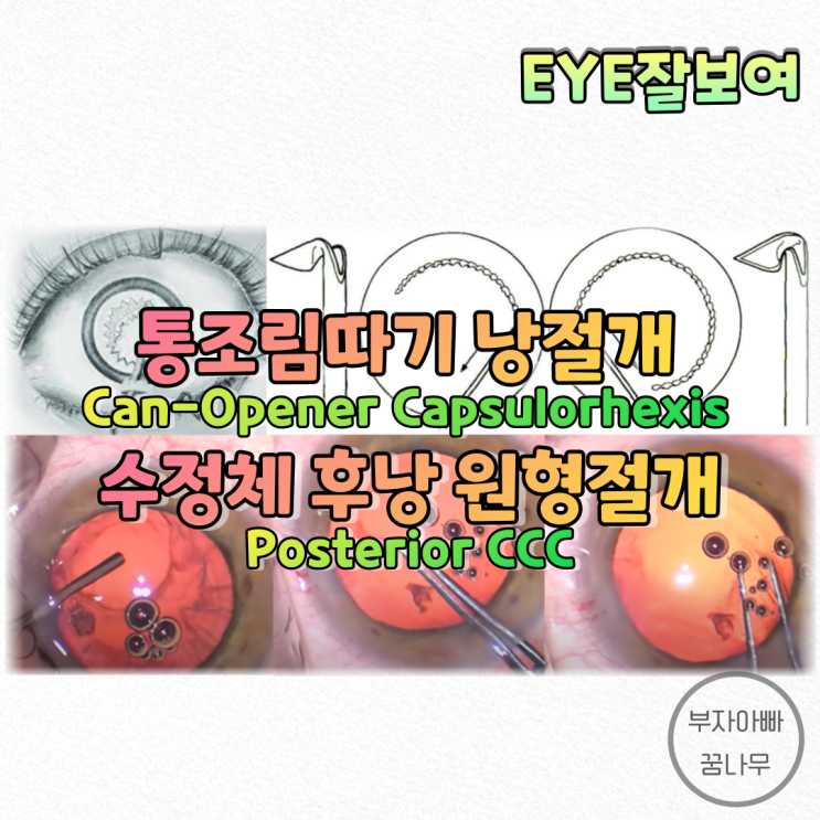 [EYE잘보여] 백내장수술 통조림따기 낭절개(Can Opener Capsulotomy), 후낭절개(Posetrior CCC