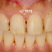 앞니 오래된 치아 라미네이트 재치료 - 충치로 인해 변색이 발생되어 새롭게 교체