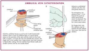 Umbilical Catheter(UVC, UAC) : 네이버 블로그