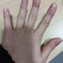 손가락 관절 통증이 느껴진다면 손가락 보호대를 착용해보자!
