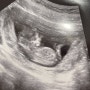 임신12주 : 1차 기형아 검사 하고왔어요.