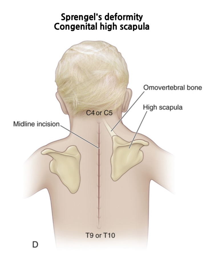 선천성 높은 어깨뼈 / Sprengels Deformity / Congenital high scapula : 네이버 블로그