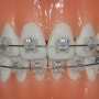 교정치료의 두번째 단계, 치아배열