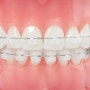 치아교정 치료의 시작, 장치의 부착(DBS)