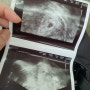 임신 초기 일기(4주~8주)