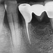 목동치과 치아를 살리는 재근관치료(Re-Endodontic Treatment)