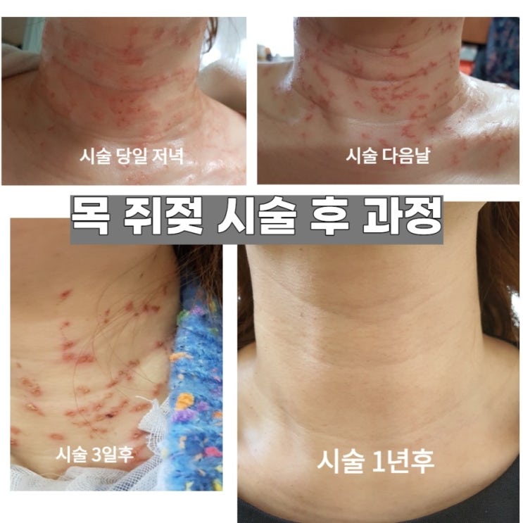 목 쥐젖 제거 시술후 과정안내 / 성북구 장위동 피부과 진료 아산드림의원 : 네이버 블로그