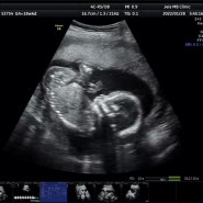 [임신 기록]임신 19주차 증상 기록/갈색혈/태동/자궁경부길이/자궁경부폴립/자궁경부용종/임산부 일상