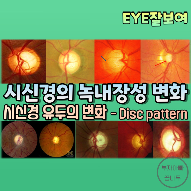 [EYE잘보여] 시신경의 녹내장성 변화 (1) - 시신경 유두의 변화: DISC PATTERN : 네이버 블로그