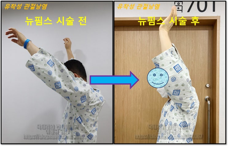 치료되지 않는 오십견...어떻게 치료하나?