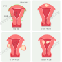[임신 준비] 난임의 원인, 자궁근종? 점막하근종, 나팔관 조영술