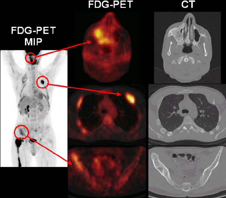 how-does-fdg-pet-scan-work-mri-chandigarh