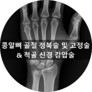 [부산 성가병원] 손목 콩알뼈 골절 환자분의 정복술 및 고정술, 척골 신경 감압술을 시행하였습니다.