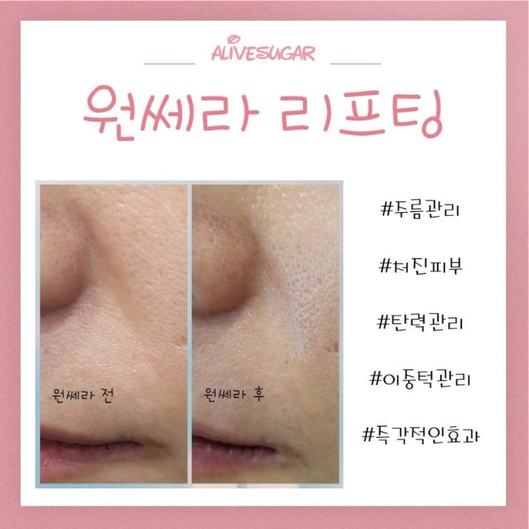 주름관리,처진피부, 탄력관리, 이중턱관리,즉각적인효과 리프팅 원쎄라 리프팅 : 네이버 블로그