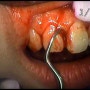 치은연하 소파술