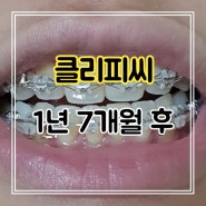 1년 7개월차 클리피씨 교정 진행 과정