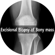 [부산 성가병원] 좌측 무릎 골연골종 환자분께 Excisional Biopsy of Bony mass(뼈덩어리 절제 생검)수술을 진행하였습니다.