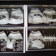 임신14주~임신16주 증상 초음파 성별알기.(둥이조카들 성장기)