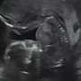 [임신 16-18주 기록] 배뭉침 증상, 배통증으로 인한 병원 방문! 근종통 때문에? feat. 열달후에 태아성장보고서, 18주 배크기
