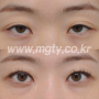 쌍꺼풀수술 전후. 안검하수 + 눈두덩이꺼짐 - 눈매교정으로 한번에 교정하기