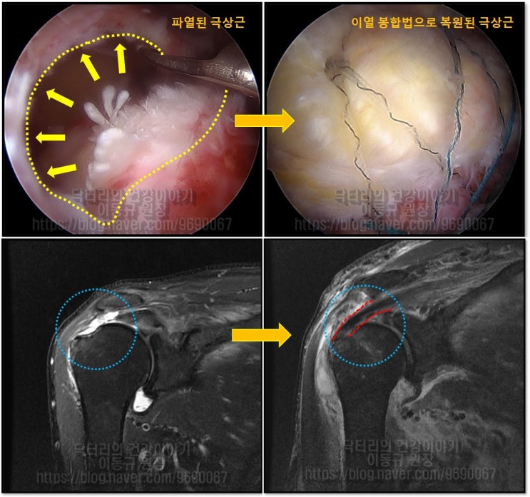 회전근개 파열. 나이는 숫자에 불과합니다. 완전히 치유해서 건강한 어깨로 건강하게 살 수 있습니다.