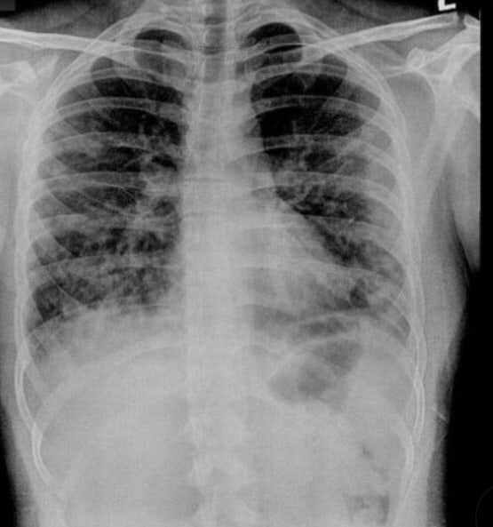 객혈(hemoptysis), 가래 피(blood tinged sputum) : 네이버 블로그