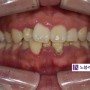 [관저동 교정] 치아가 비뚤어서 양치가 잘 안돼요. 교정과 잇몸관리!